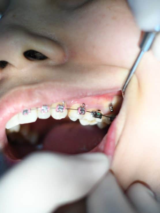 person with silver teeth braces